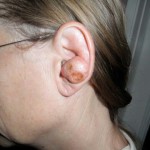Cancerous Lump on Dr. Volmert's Ear
